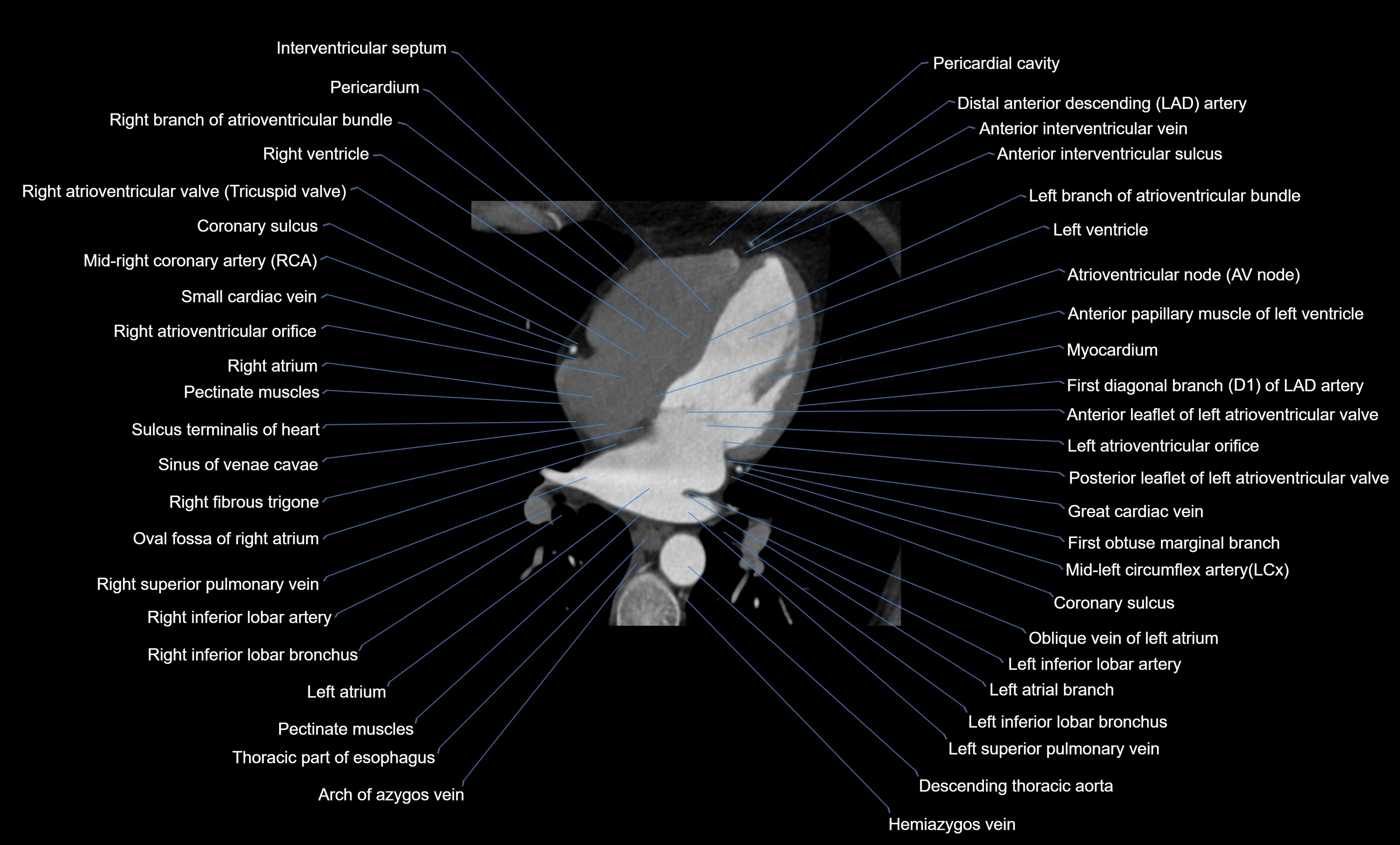 CT heart (coronary angiogram) four chamber view  cross sectional anatomy labelled radiology image -00029.webp